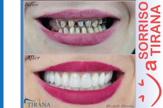 Terapi , Terapi dentare , mbushje dhembi , terapi kanalare , terapi endo , terapi endodonti , pastrim i gurezave stomatolog per femije , dental smile clinic in tirana , estetik dentare , estetik dhe higjien dentare , Luna Dental Clinic